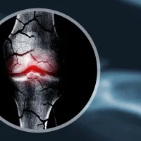 These “forever chemicals” could be weakening kids’ bones for life