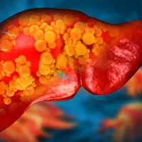 Mayo Clinic discovers rare gene mutation that causes fatty liver disease