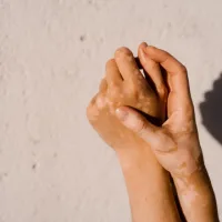 Landmark vitiligo cream targets immune cells that disrupt pigmentation