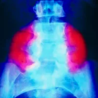 Stem cell patch reverses brain damage in fetuses with spina bifida