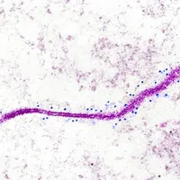 STAT+: Cancer cells can ‘barf’ proteins onto their cell surface. That may create new targets for immunotherapies